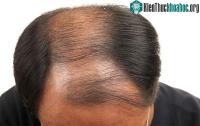 Ảnh Tìm ra được biện pháp dùng mùi hương để trị bệnh hói