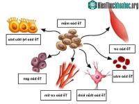 Ảnh U quái: Khối u phát triển không theo quy luật nào, có thể mọc được cả răng lẫn tóc