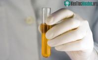 Ảnh Xét nghiệm nước tiểu ngay tại nhà phát hiện sớm bênh ung thư tuyến tiền liệt