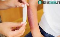 Ảnh Bị bỏng thì kiêng ăn gì?