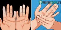 Ảnh Cẩn thận với căn bệnh khiến cho ngón tay ngón chân bạn đổi màu trắng xanh khi gặp trời lạnh