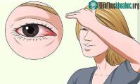 Ảnh Vì sao mắt chúng ta lại bị đỏ ngầu sau khi tỉnh giấc?
