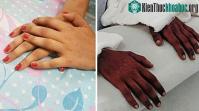 Ảnh Cô gái đã được ghép tay từ nam thanh niên da đen, 2 năm sau điều kỳ diệu bỗng xảy ra