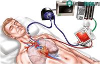 Ảnh ECMO là gì? Khi nào bệnh nhân cần phải can thiệp ECMO?