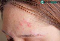 Ảnh Vì sao con người lại bị mụn trứng cá?
