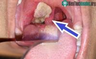 Ảnh Cách phân biệt được bệnh bạch hầu và viêm họng