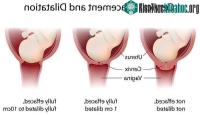 Ảnh "Nở 10 phân" khi sinh em bé là thế nào?