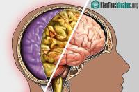 Ảnh Bệnh viêm màng não cấp không được điều trị kịp thời nguy hiểm thế nào?