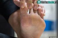 Ảnh Phủ nano trên tất để trị chứng hôi chân