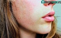 Ảnh Những lầm tưởng khiến bệnh eczema khó chữa khỏi