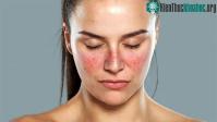Ảnh Lupus ban đỏ và vảy nến chúng khác nhau như thế nào?