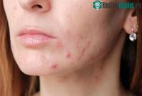 Ảnh 5 ngộ nhận về mụn trứng cá mà chúng ta thường gặp