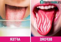 Ảnh Hướng dẫn cách chữa bỏng lưỡi khi ăn uống phải món nóng