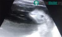 Ảnh Hình ảnh siêu âm của loài cá voi trắng trong bụng mẹ