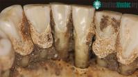 Ảnh Phân tích cao răng phát hiện thói quen dùng thuốc của người xưa