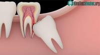 Ảnh Biến chứng với những nguy hiểm khi răng khôn mọc ngầm