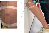 Ảnh Phát triển thành công trên da nhân tạo có thể bầm tím như thật