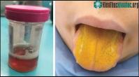 Ảnh Bệnh rối loại tự miễn hiếm gặp gây vàng lưỡi và nước tiểu đậm màu ở trẻ nhỏ