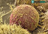 Ảnh Người phụ nữ đầu tiên trên thế giới chữa khỏi HIV bằng biện pháp cấy tế bào gốc