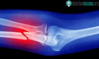 Ảnh Nghiên cứu thử nghiệm dùng công nghệ ARN để chữa lành xương