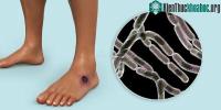 Ảnh Chất độc bệnh than có thể sẽ là chìa khóa cho những biện pháp giảm đau mới